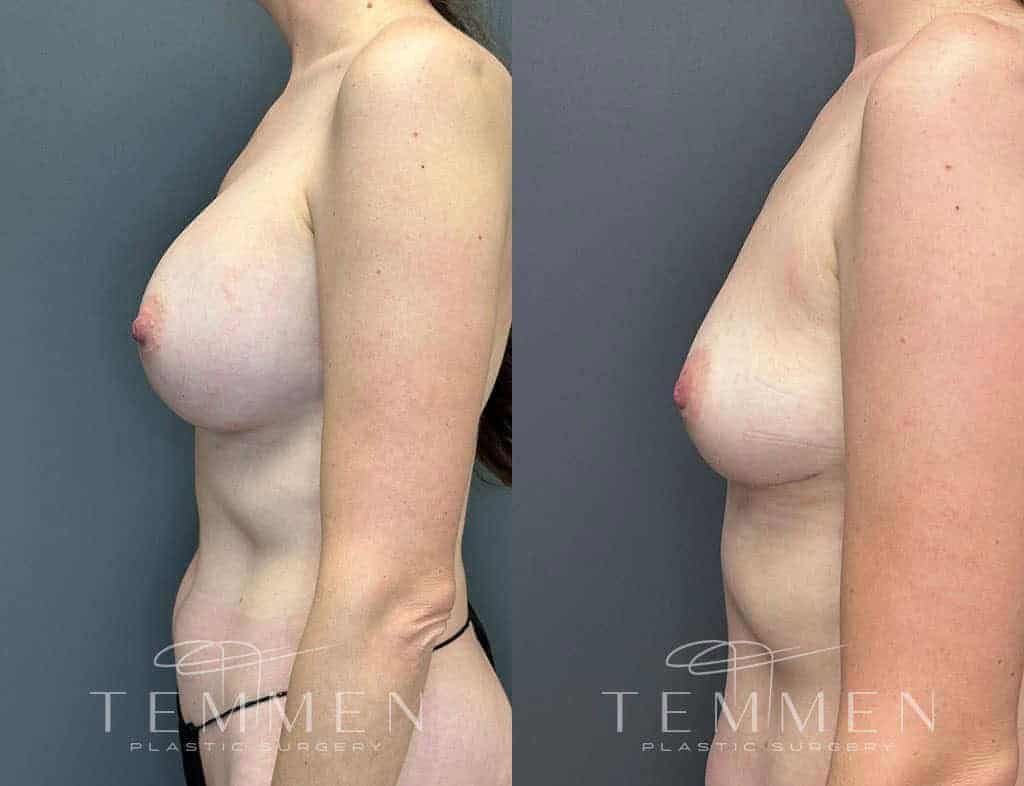 Breast Implant Removal Before & After