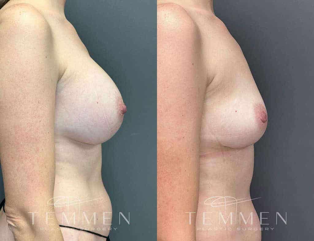 Breast Implant Removal Before & After