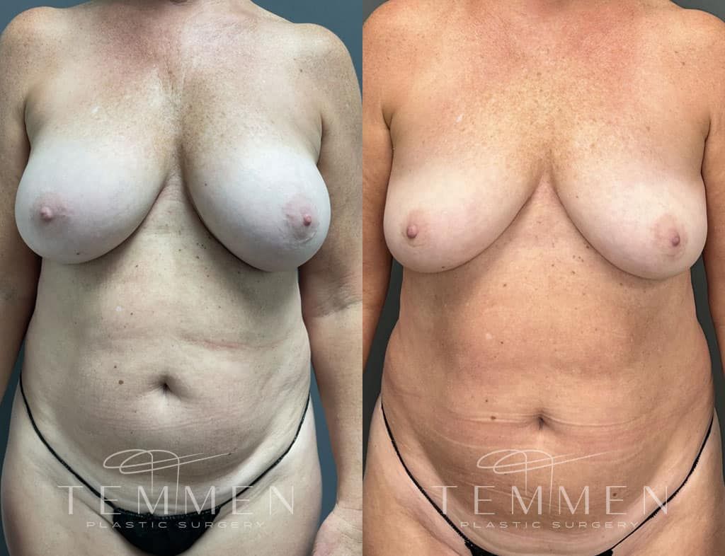 Breast Implant Removal Before & After