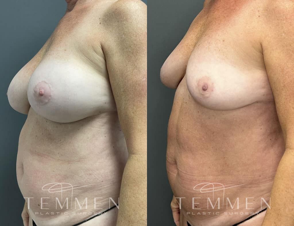 Breast Implant Removal Before & After