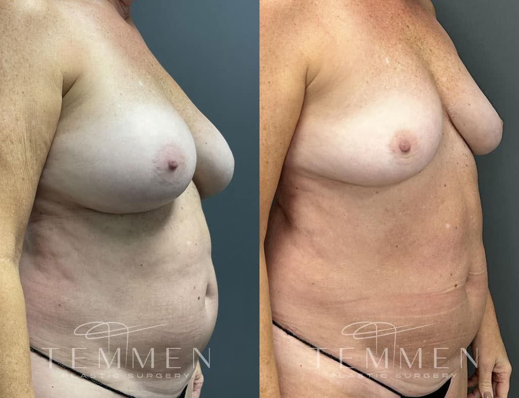 Breast Implant Removal Before & After