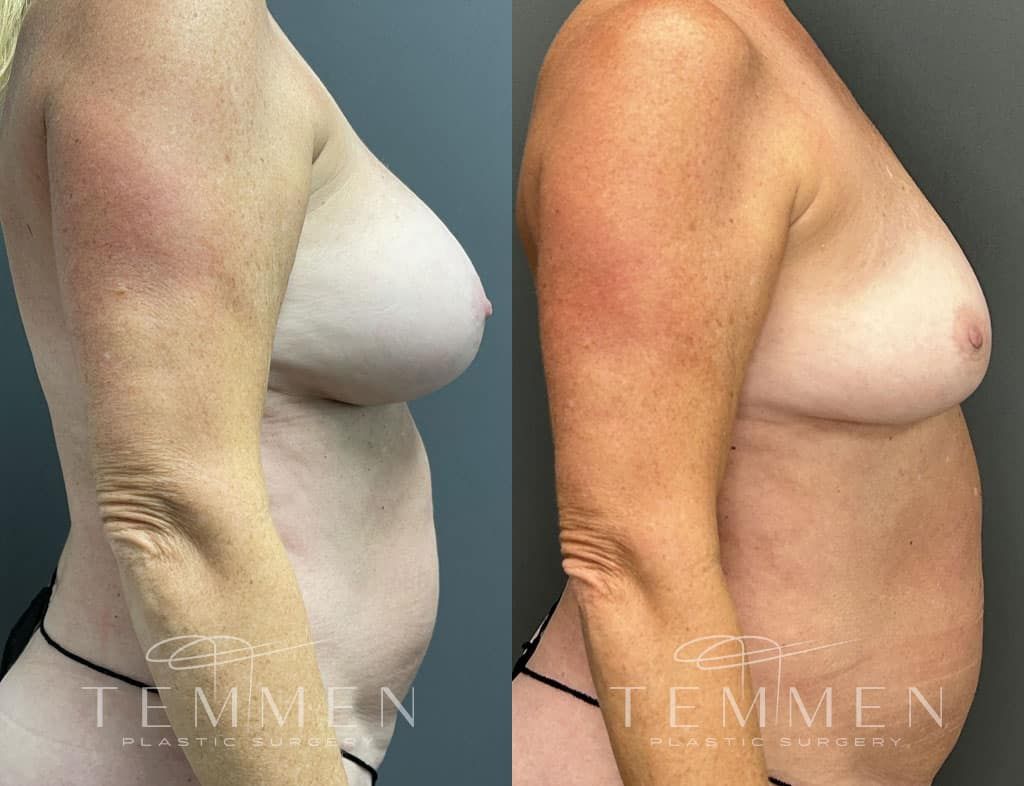 Breast Implant Removal Before & After