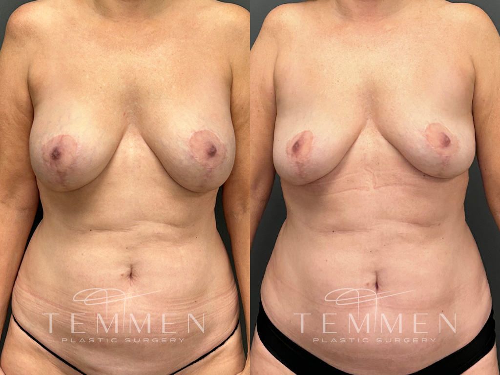 Breast Implant Removal Before & After