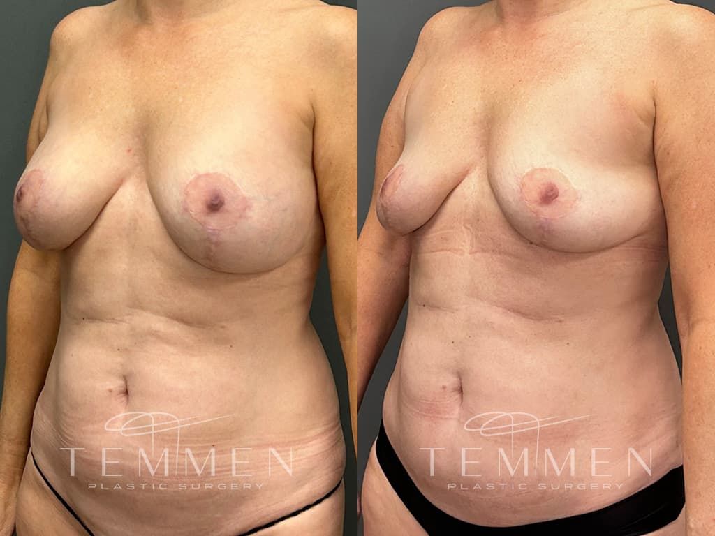 Breast Implant Removal Before & After