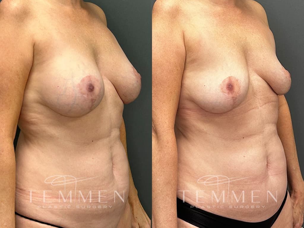 Breast Implant Removal Before & After