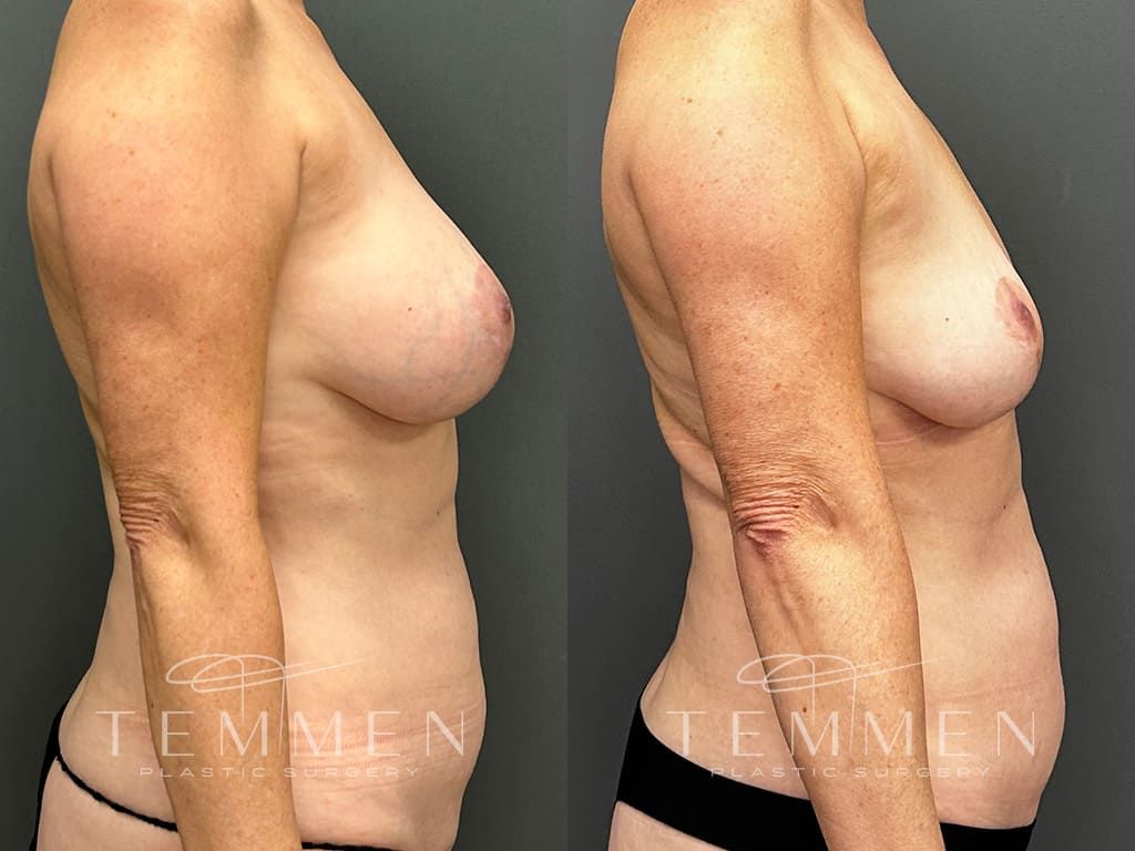 Breast Implant Removal Before & After