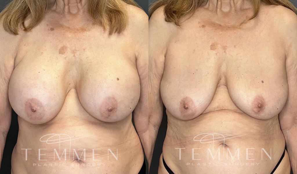 Breast Implant Removal Before & After
