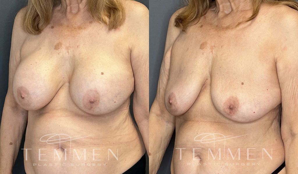 Breast Implant Removal Before & After