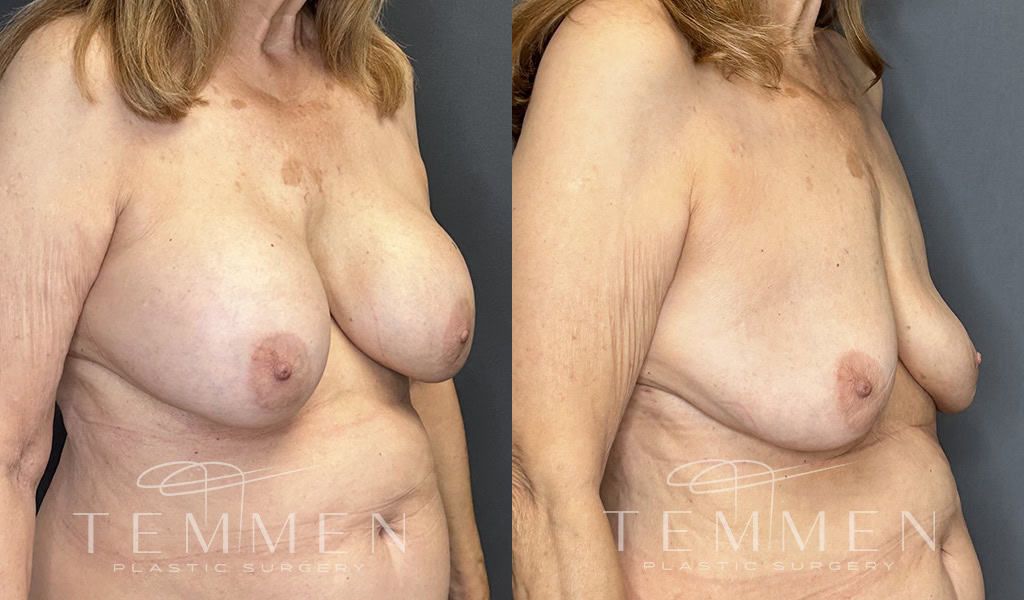 Breast Implant Removal Before & After