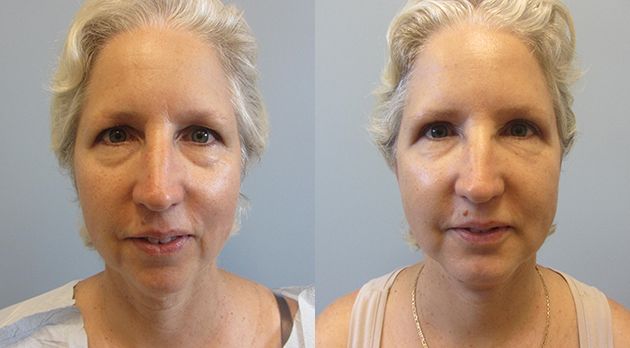 Neck Lift Before & After