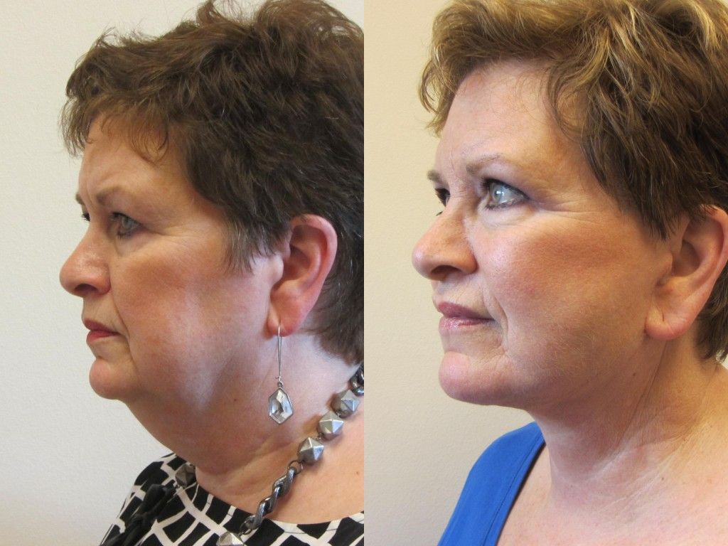 Neck Lift Before & After