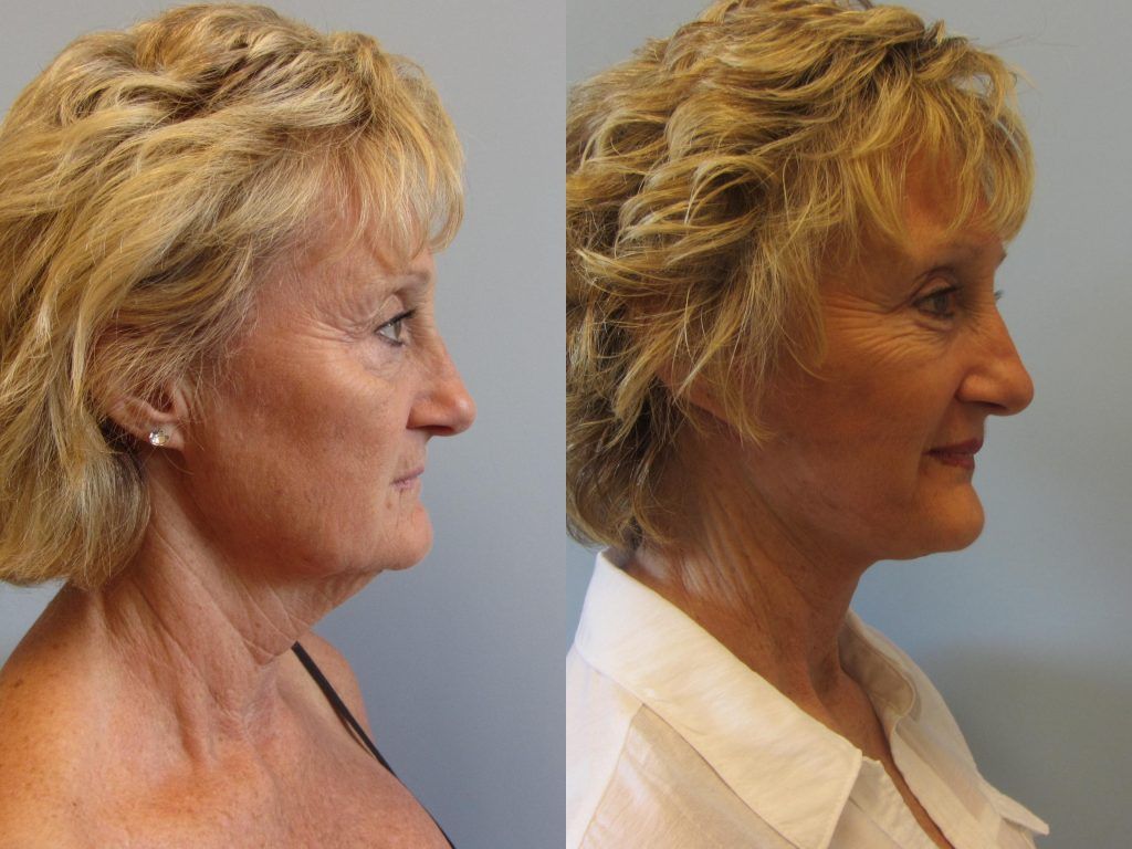 Neck Lift Before & After