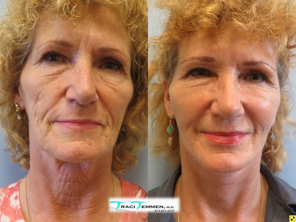 Neck Lift Before & After