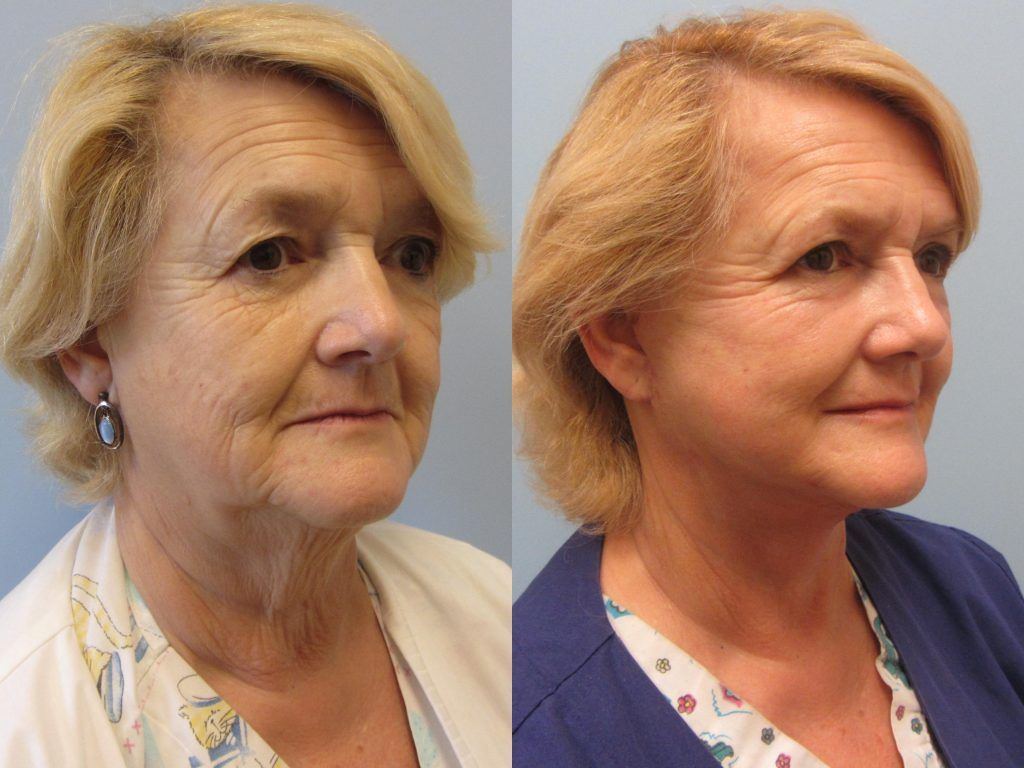 Neck Lift Before & After