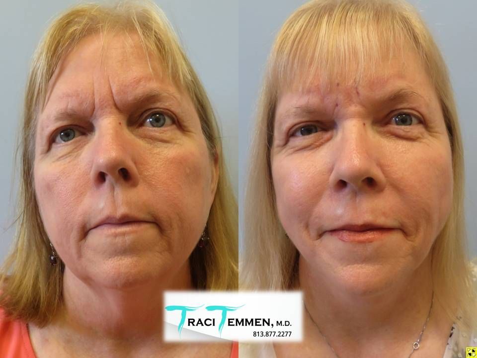 Neck Lift Before & After
