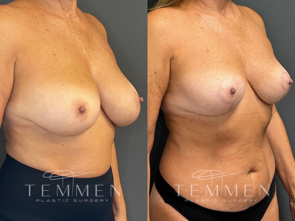 Breast Reduction Before & After