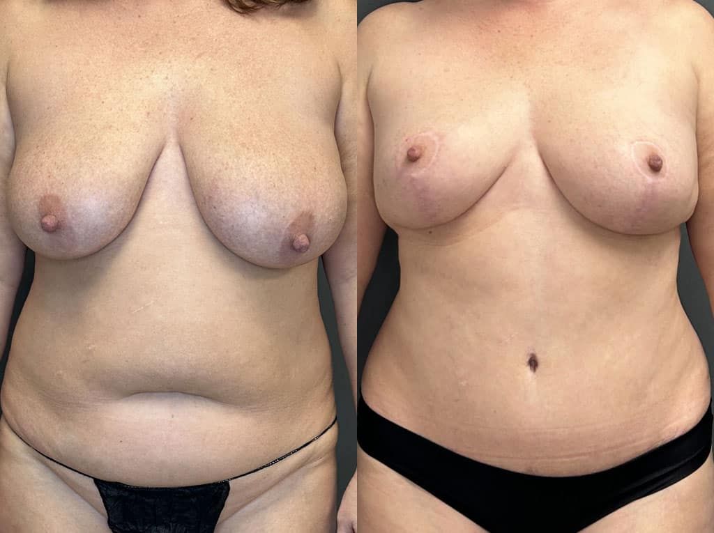 Breast Reduction Before & After