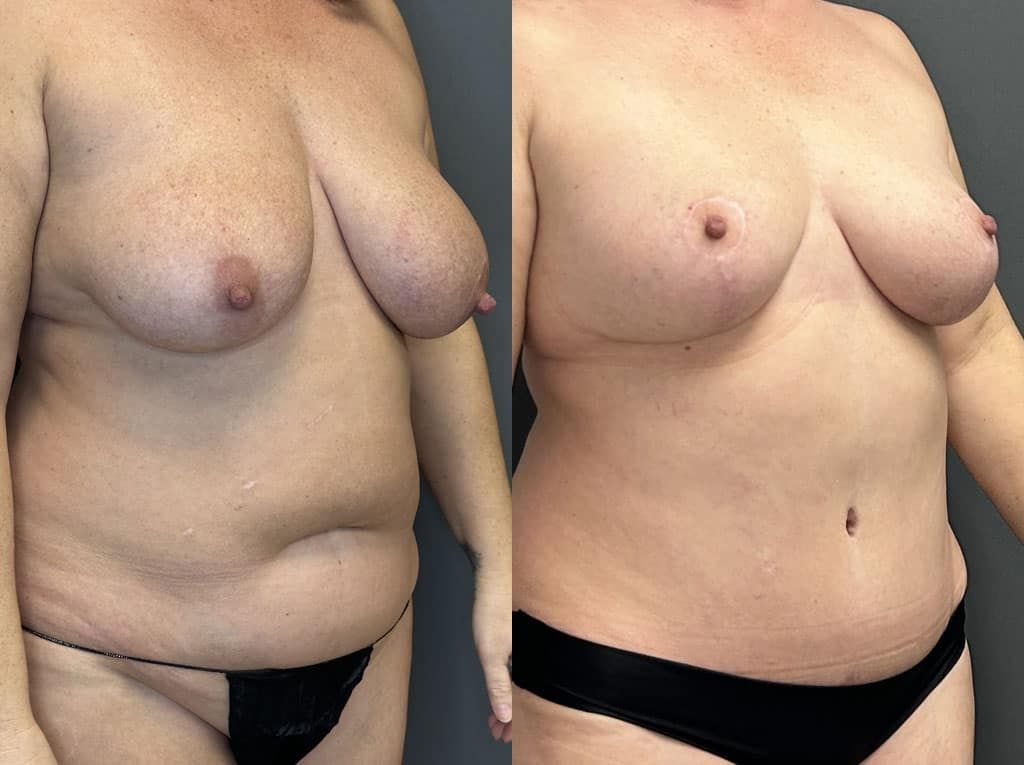 Breast Reduction Before & After