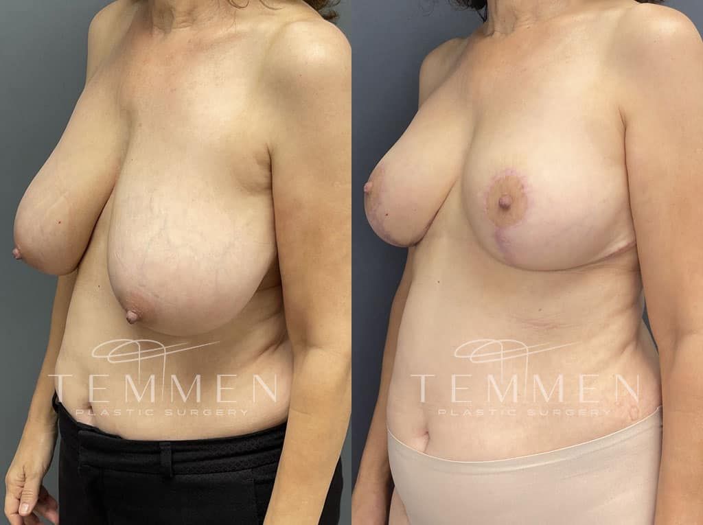 Breast Reduction Before & After