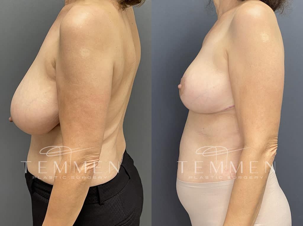 Breast Reduction Before & After