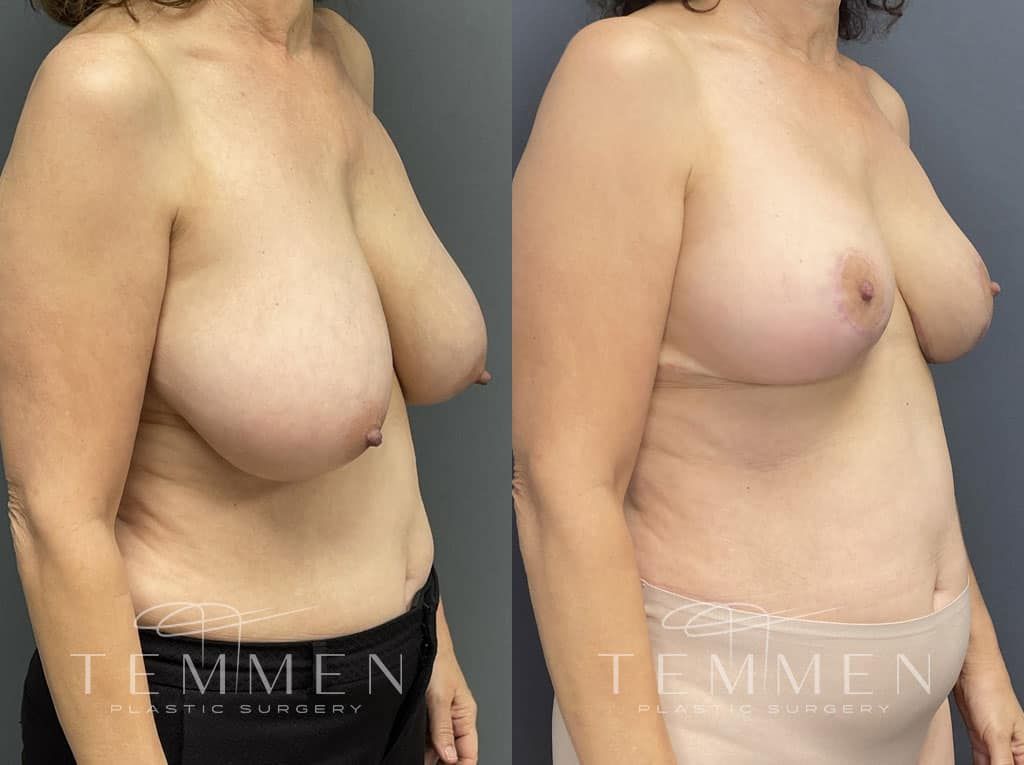 Breast Reduction Before & After