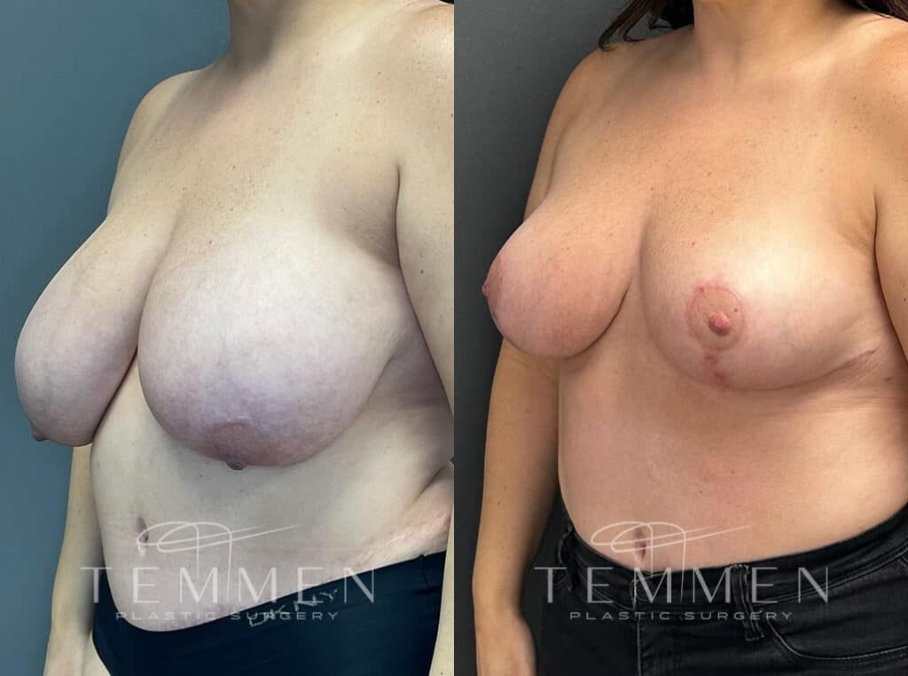 Breast Reduction Before & After