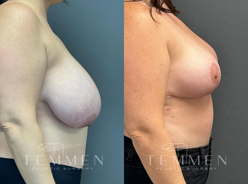 Breast Reduction Before & After