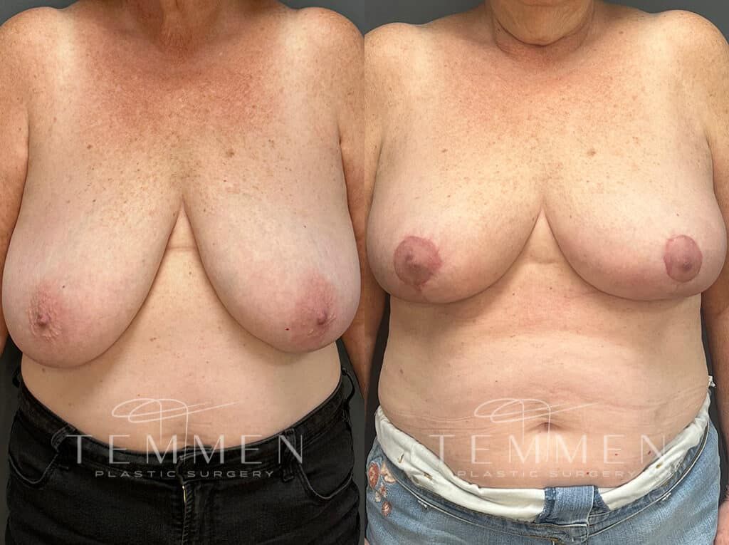 Breast Reduction Before & After