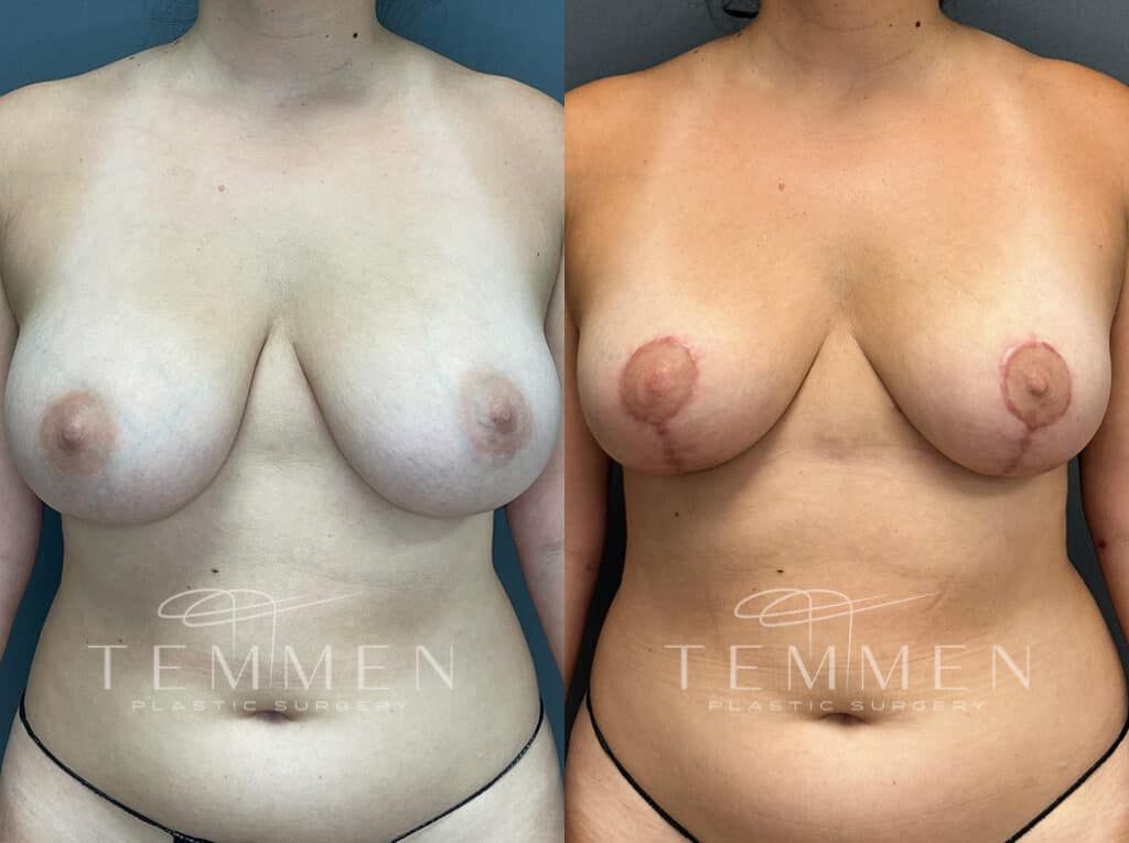 Breast Reduction Before & After