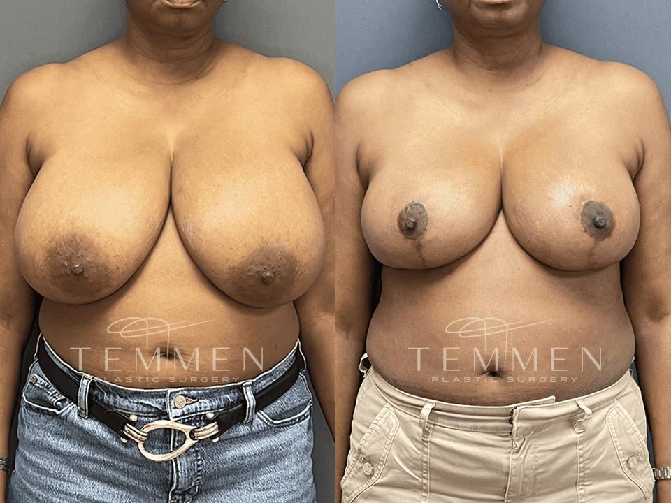Breast Reduction Before & After