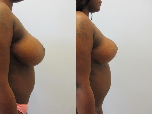Breast Reduction Before & After