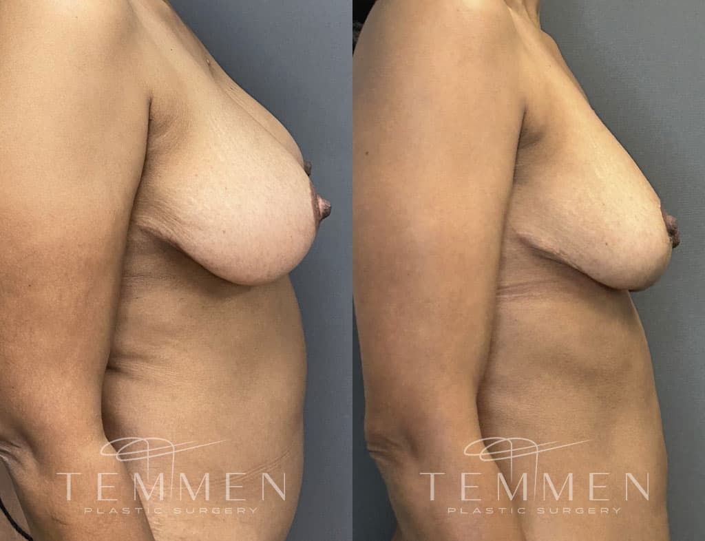 Breast Reduction Before & After