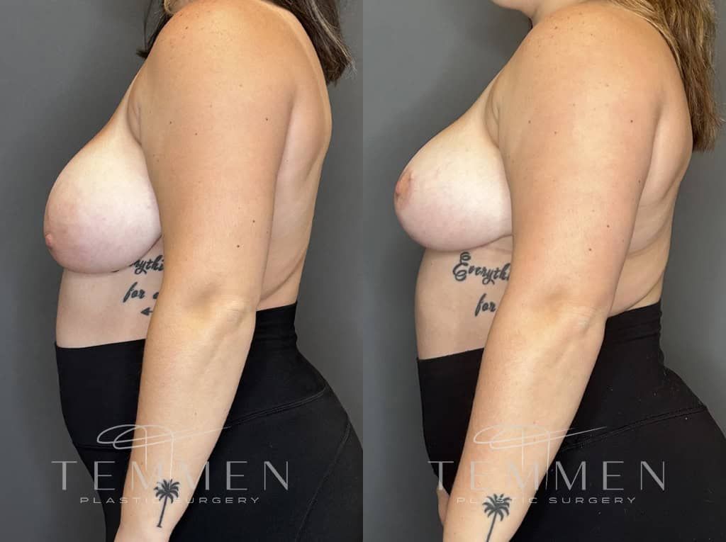 Breast Reduction Before & After