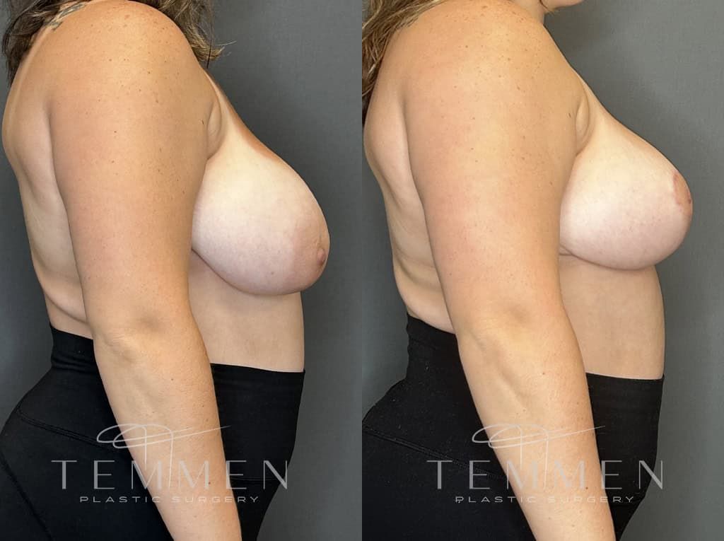 Breast Reduction Before & After
