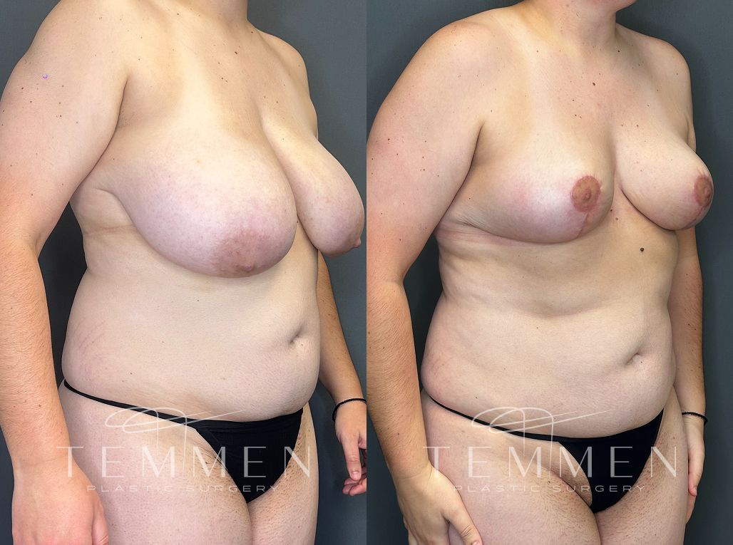 Breast Reduction Before & After