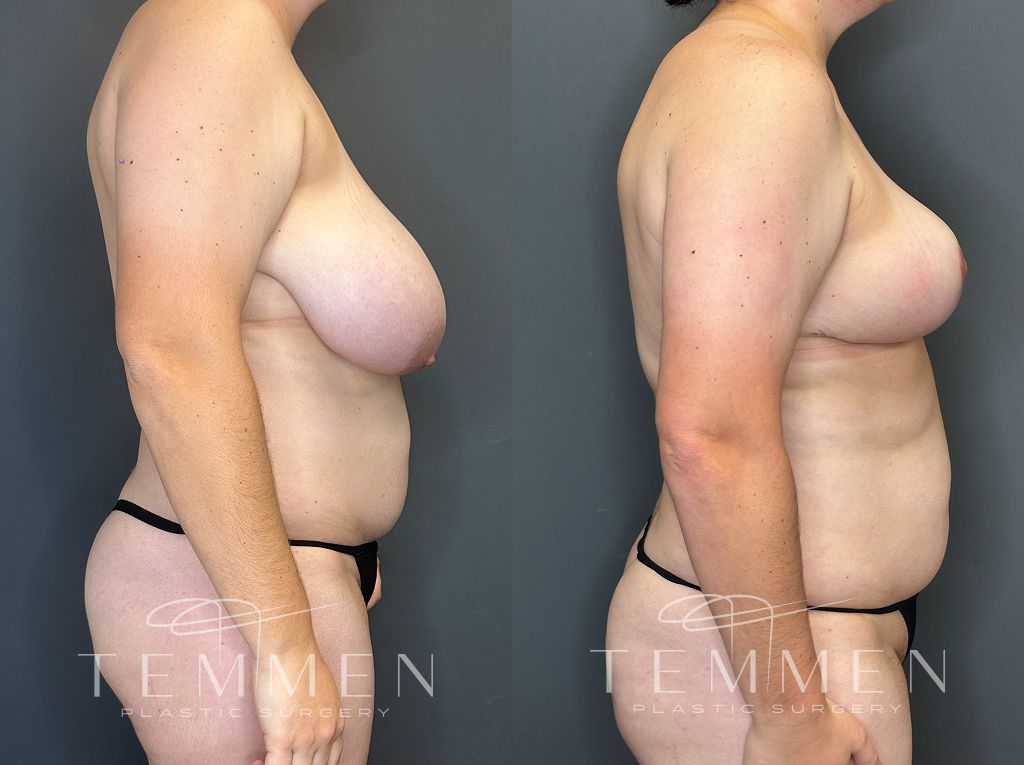 Breast Reduction Before & After