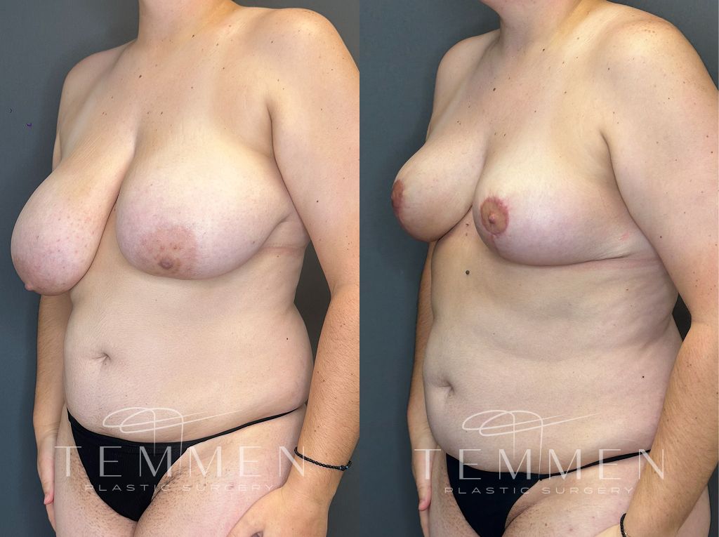 Breast Reduction Before & After