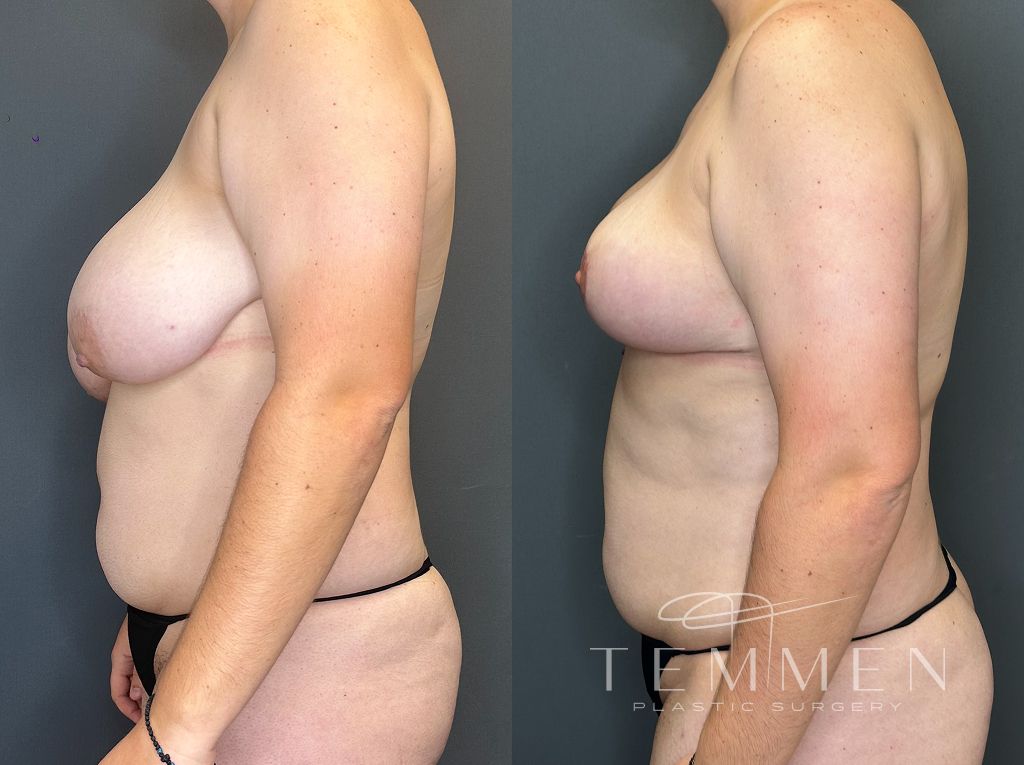 Breast Reduction Before & After