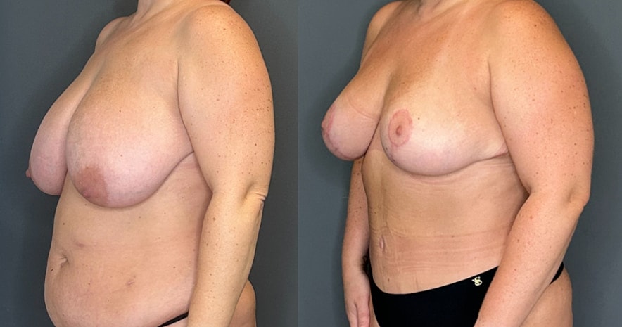 Breast Reduction Before & After