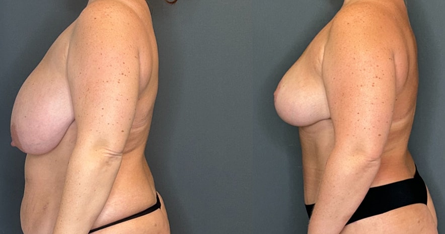 Breast Reduction Before & After