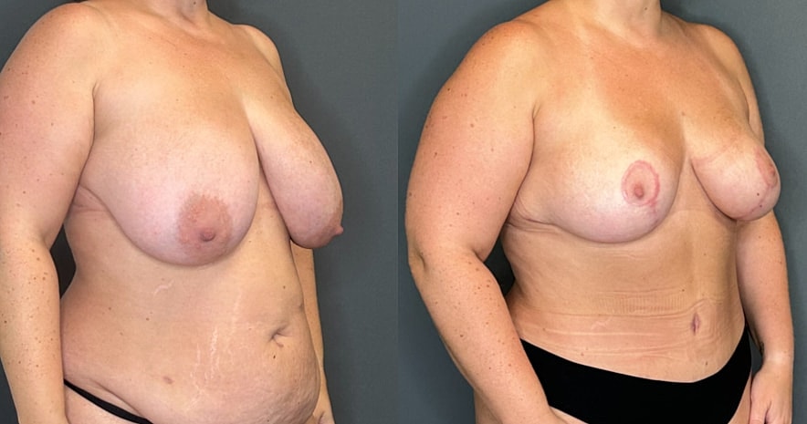 Breast Reduction Before & After