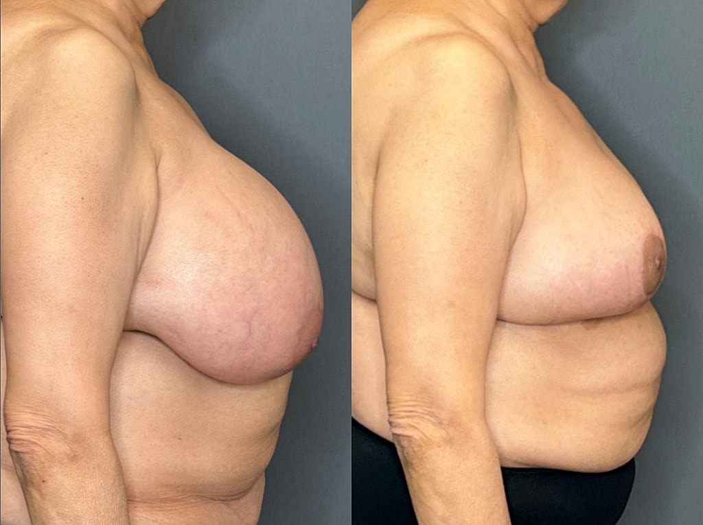 Breast Reduction Before & After