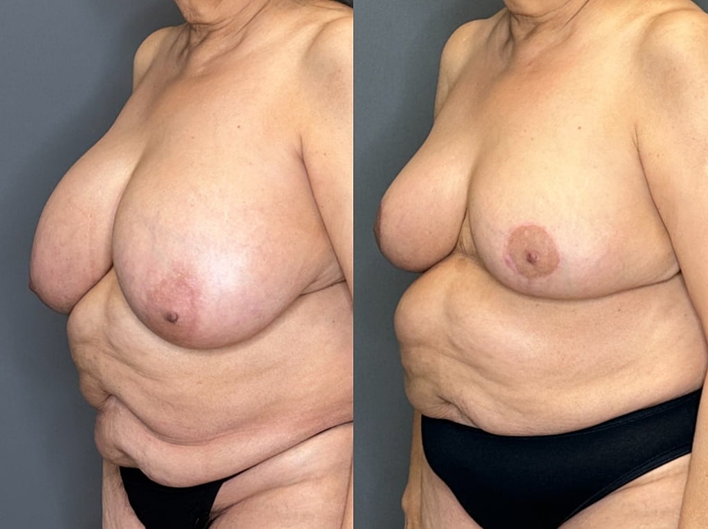 Breast Reduction Before & After