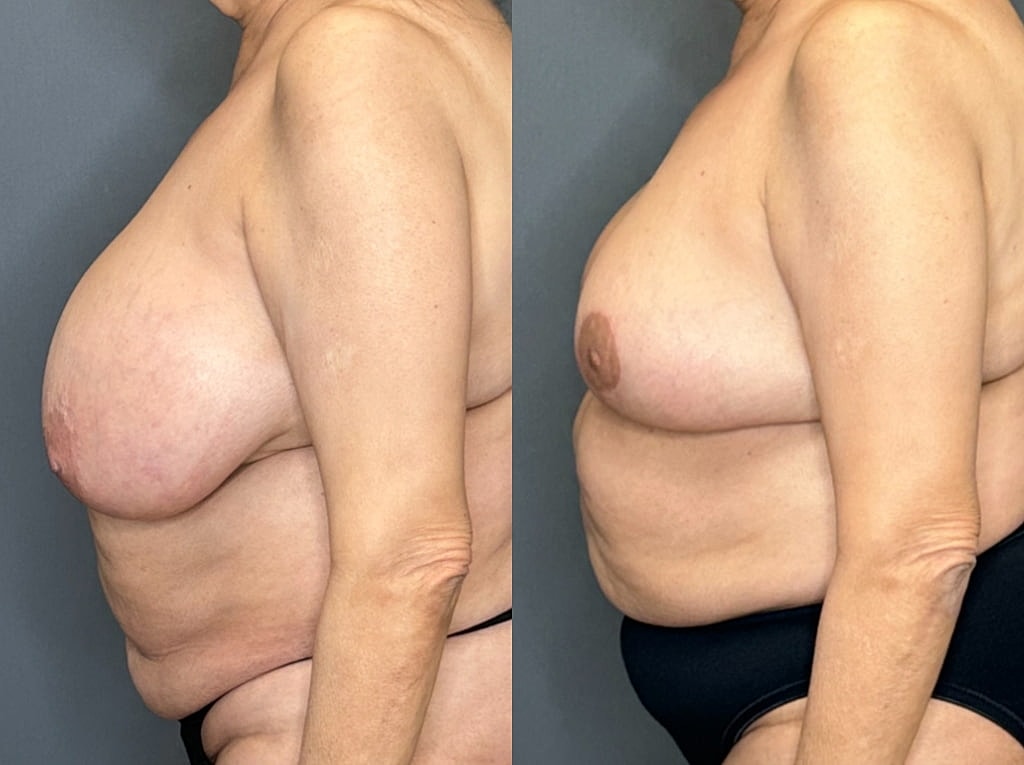 Breast Reduction Before & After