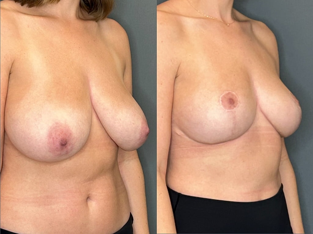 Breast Reduction Before & After