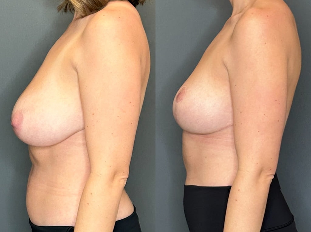 Breast Reduction Before & After