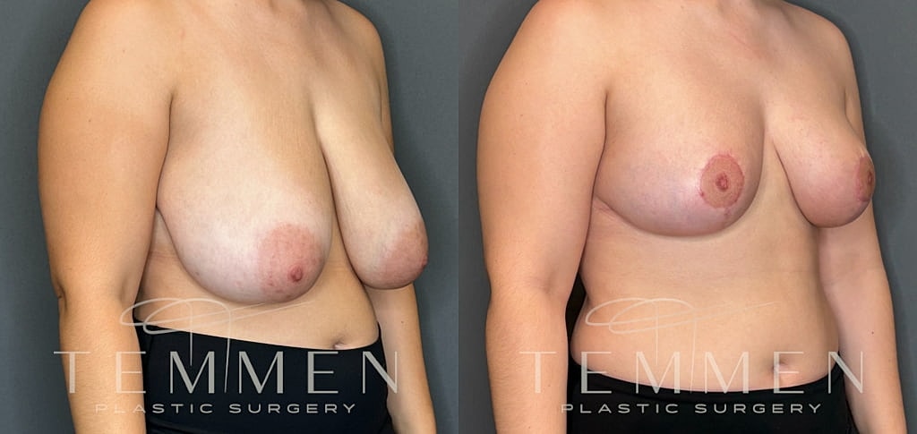 Breast Reduction Before & After