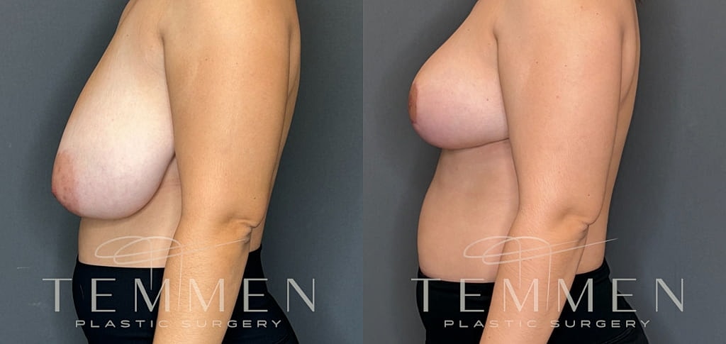 Breast Reduction Before & After