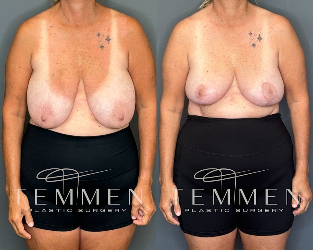 Before and after plastic surgery results comparison.