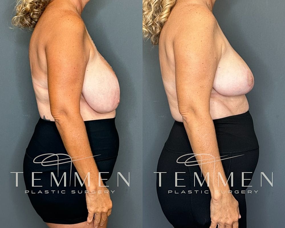 Before and after plastic surgery side view.